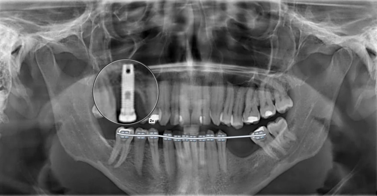 Radiografia panorâmica com desenhos do BazzoDraw: Aparelho no arco inferior e o implante ampliado com a lupa.