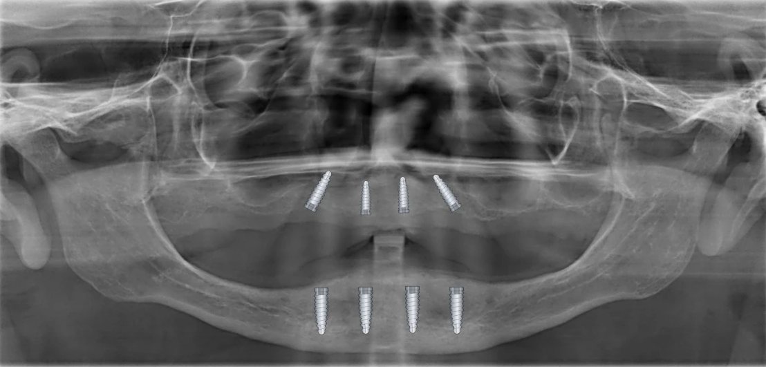 Radiografia panorâmica com desenhos do BazzoDraw: Posição dos implantes superiores e inferiores, antes da cirurgia.