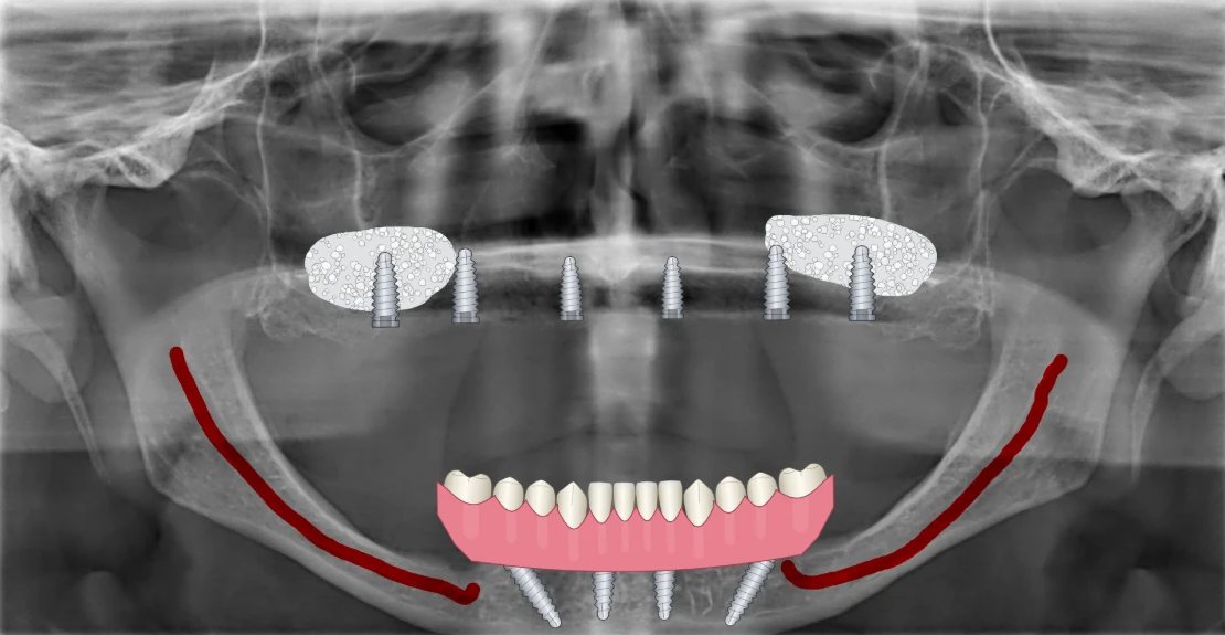 Radiografia panorâmica com desenhos do BazzoDraw: Protocolo sobre implantes, enxerto nos seios maxilares e o canal mandibular marcado.
