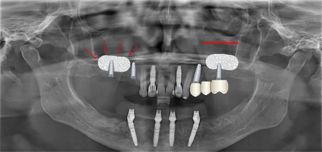 Radiografia panorâmica com desenhos do BazzoDraw: Enxerto no seio maxilar, implantes e coroas, com setas para explicar.