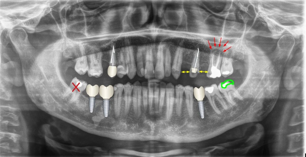 Radiografia panorâmica com desenhos do BazzoDraw: Implantes com coroa, pino e núcleo, extração, setas e marca-texto.